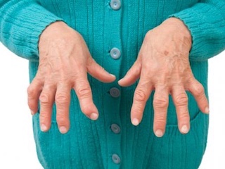 salud-artritis-reumatoide-WB