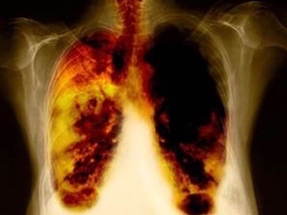 salud-cancer-pulmon-WB