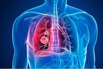 web-62-hipertension arterial pulmonar