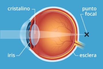 web-62-presbyopia