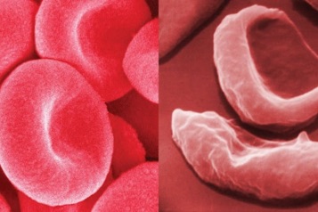 web-62-anemia-falciforme