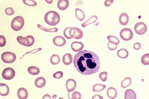 salud-anemia