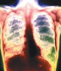 salud-Tuberculosis