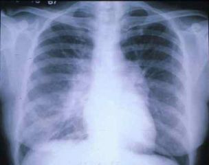 salud-fibrosis-pulmonar