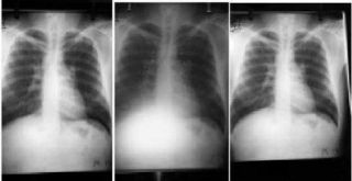 slud-fibrosis-pulmonar
