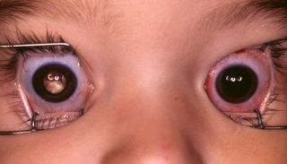 salud-retinoblastoma