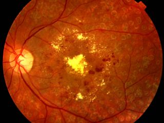 salud-retinopatia