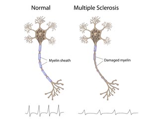 esclerosis multiple
