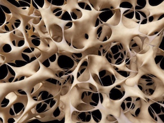 web-62-osteoporosis